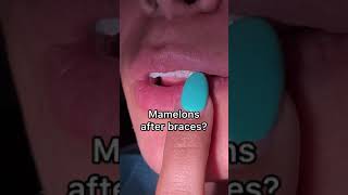 Braces off  Mamelons after braces  Tooth Time Family Dentistry New Braunfels [upl. by Llerrac]