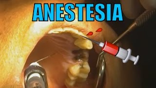 ANESTESIA DENTAL HD [upl. by Nwahsd]