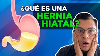 ¿QUÉ ES UNA HERNIA HIATAL [upl. by Hannaj]