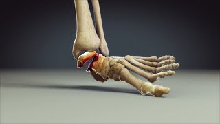 Ankle Fracture Animation  Mechanism of Injury Animation [upl. by Yanaton50]