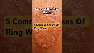 5 Common Causes of Tinea Ring Worm tinea skin care skindisease [upl. by Fridell608]