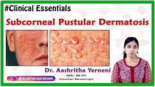 Subcorneal Pustular Dermatosis  Clinical Essentials   Dr Aashritha yerneni [upl. by Hy95]