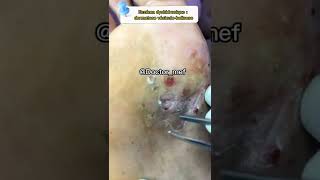 Dermatose vesiculobulleuse  Eczéma deshydrosique santé conseils infection [upl. by Dal858]