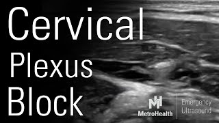 Cervical Plexus Block [upl. by Koressa]