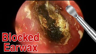 BIGGEST Ear Wax Difficult Removal  EP5  Doctor Anh [upl. by Aennyl667]