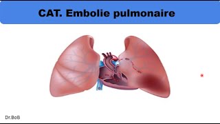 conduite à tenir devant une embolie pulmonaire [upl. by Suzetta]