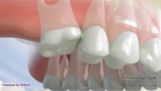 Ectopic Molar Eruption  Orthodontic Treatment [upl. by Ormond]