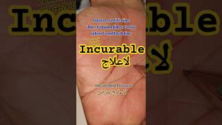 لا علاج مرض Incurable disease palmistry دستشناسی rmpalmist yousafpalmist astrologytiktok [upl. by Anrim999]