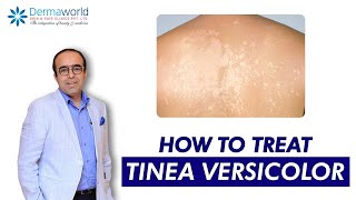 Tinea versicolor  Dr Rohit Batra  Tinea Versicolor Treatment  How to treat Tinea Versicolor [upl. by Niamart297]