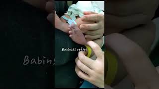 Babinski reflex in infants [upl. by Okim]