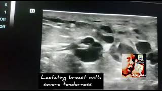 breast abcess with duct ectasia ultrasound by DrHaissam Aref DMSMSc MD ultrasound [upl. by Cattan]