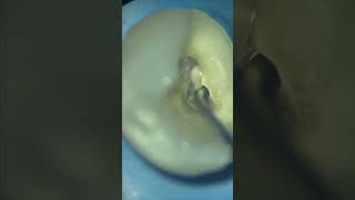 Single cone with MTA sealer  Endoseal apexlore endodontics [upl. by Winfrid]