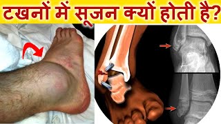 टखनों में सूजन क्यों होती है कारण और घरेलू उपाय ।Reasons for Ankle Swelling and treatment [upl. by Diandra136]