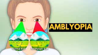 Amblyopia Causes Signs and Symptoms Diagnosis and Treatment [upl. by Eenaej]