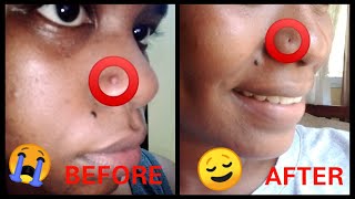 HOW TO GET RID OF A NOSE PIERCING BUMPKELOID FAST [upl. by Airtened214]