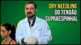 Dry Needling do Tendão Supraespinhal  VEJA EM TEMPO REAL [upl. by Gorga708]