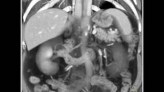 Duplication of IVC [upl. by Seidnac]