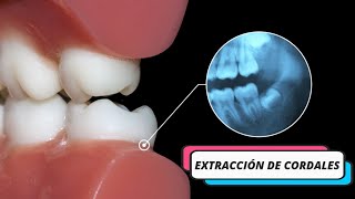 Cirujana especialista Extracción Cordales  Maxilofacial ¿En qué casos se requiere esta cirugía [upl. by Ecila]