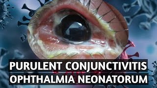 purulent conjunctivitis hyperacute bacterial conjunctivitis ophthalmia neonatorum in hindi 2021 [upl. by Paucker]