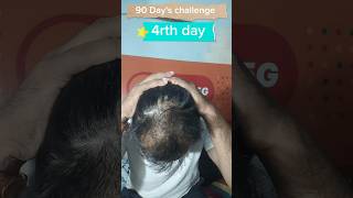 4rth day used minoxidil morr f5 results  adivasi hair oil results minoxidil adivasihairoilreview [upl. by Ela]