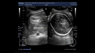 Ultrasound Video showing Oligohydromnios  almost Anhydramnios  with Pregnancy of 30 weeks [upl. by Refinnaj702]