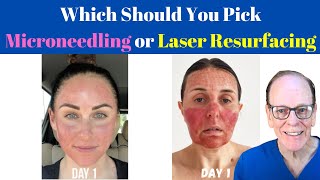 Should You Get Microneedling or Laser Resurfacing  Plastic Surgeons Advice [upl. by Tillford926]