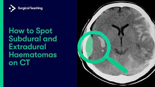 Extradural vs Subdural Haematomas  How do we Diagnose them on CT [upl. by Attelrak]