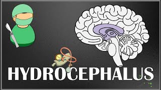 Hydrocephalus  Causes Types Signs and Symptoms Pathophysiology Diagnosis and Treatment [upl. by Carlick]