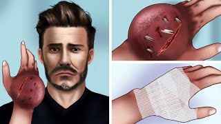 ASMR Help David Beckham treat a bite on the back of his hand [upl. by Molahs]