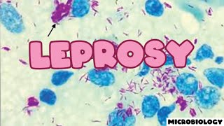 Leprosy  SAQ  Microbiology [upl. by Innis863]