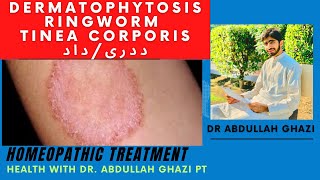 Dermatophytosis  Ringworm  Tinea Corporis داد  ددری  Homeopathic Treatment  Dr Abdullah Ghazi [upl. by Ilaire]