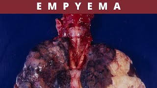 Empyema Causes Symptoms Treatment and Prevention [upl. by Anawat]