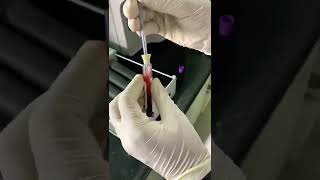 Esr westergren method laboratory testing test bloodtest khanzaki path medicalstudent [upl. by Lemire362]