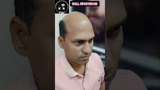 Hair Loss Problem 😭  HAIR PATCH WITH ORIGINAL HAIR  short shorts hairpatch [upl. by Akalam]