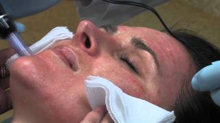 Dr Mark B Taylor Review of Dermapen Micro Needling  Gateway Aesthetics [upl. by Kosak780]