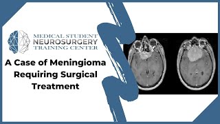 A Case of Meningioma Requiring Surgical Treatment [upl. by Kress574]