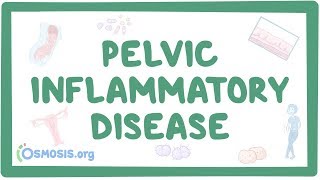 Pelvic inflammatory disease  causes symptoms diagnosis treatment pathology [upl. by Eseela]