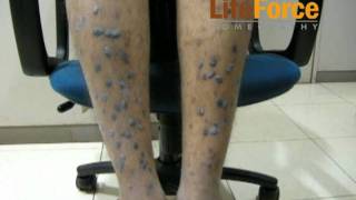 Severe Hypertrophic Lichen Planus with Severe Lichenification on Legs Treated at Life Force [upl. by Boony635]