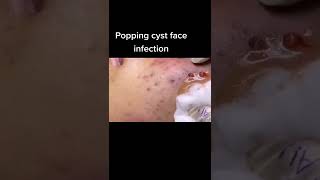 Cystic Acne Removal amp Inflammatory Acne [upl. by Goines339]