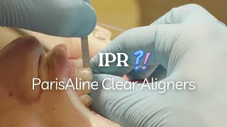 Performing IPR with ParisAline Clear Aligners A Simple Guide [upl. by Nnep480]