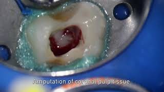 MTA pulpotomy – Video abstract ID 134315 [upl. by Waly]