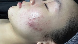 Remove perennial blackheads around lips and under chin 2024 [upl. by Essilem]