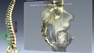 03 Concept of Pelvic Incidence and Required LL 02 LAN [upl. by Nevin]