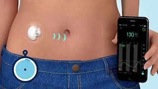 What is Continuous Glucose Monitoring CGM [upl. by Asilav]