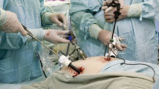 Laparoscopic Cholecystectomy [upl. by Litnahs]