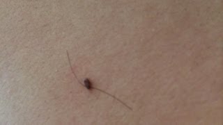 How To Get Rid of Skin Tags Naturally [upl. by Yklam]