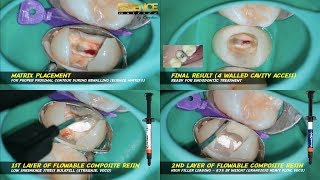 rewalling pre endodontic build up xtrabase heavy flow voco essence matrix© maxillary premolar [upl. by Tor]