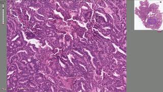 Endometrial Adenocarcinoma  Histopathology [upl. by Aiblis241]