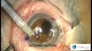 Perforating Keratoplasty PKP by Dr Alex Lange [upl. by Dry469]