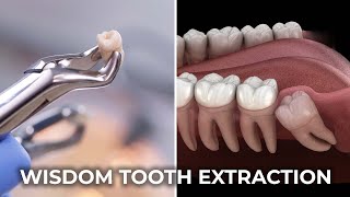 Wisdom Tooth Extraction  عقل داڈ نکالنا  The Complete Guide to Wisdom Tooth Extraction [upl. by Novyat]